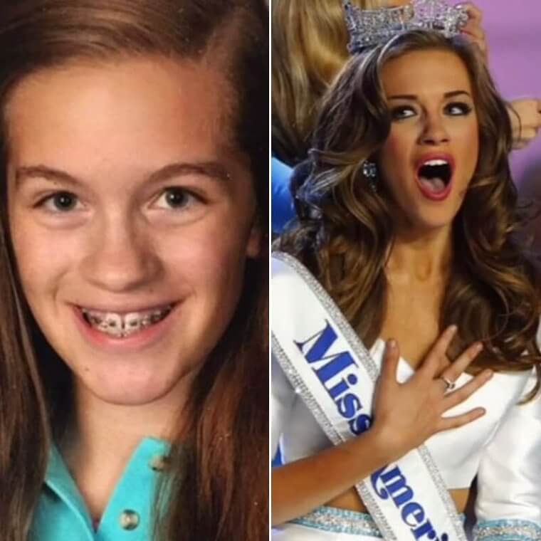 From Braces To Beauty Queen