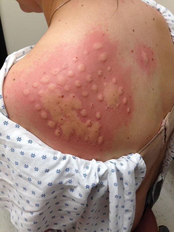 All Of The Allergic Reactions Are On This Person's Back