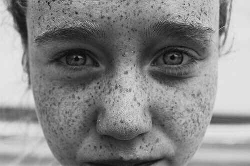 Sulfur Was Used to Remove Freckles