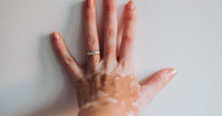 Blue-Eyed People Are Less Likely to Have Vitiligo