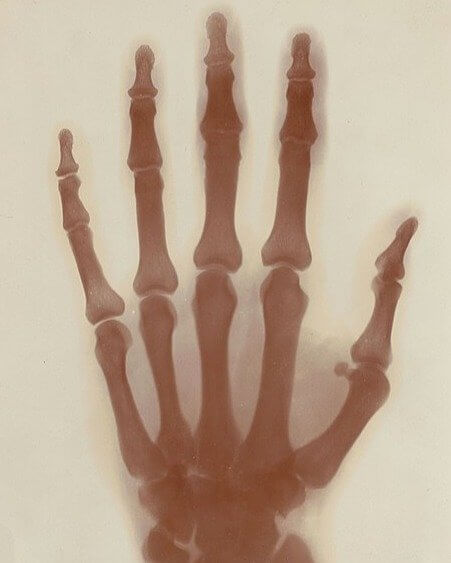 Nikola Tesla’s Hand X-Ray Taken by Himself