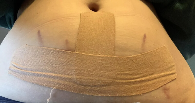 Kinesio-Tape um den Babybauch zu entlasten