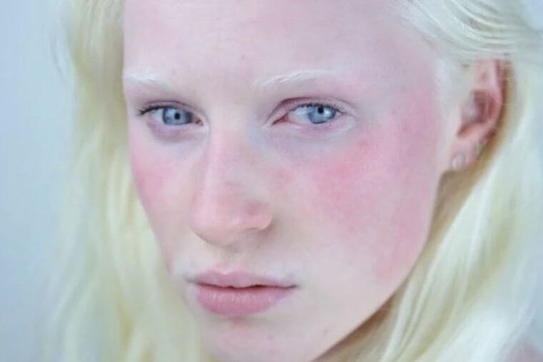Lack of Pigmentation Can Be Stunning