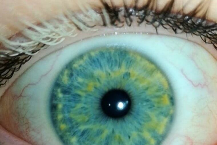 Just a Typical Case of Someone with Black and White Eyelashes