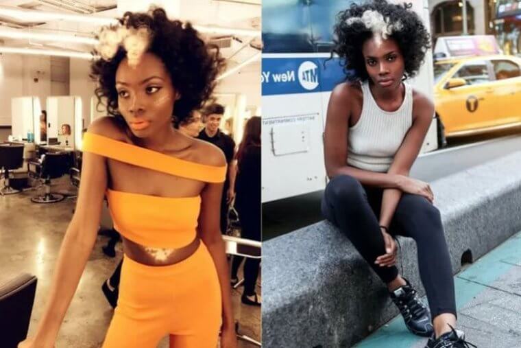 This Condition Has a Sad but Beautiful Story Behind It