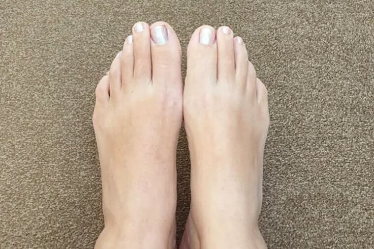 When Just Two Big Toes Aren't Enough