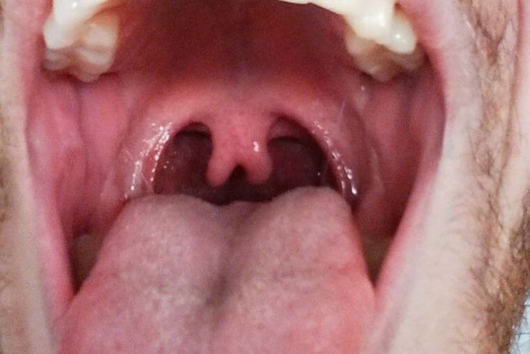 Two Dangly Things Instead of One