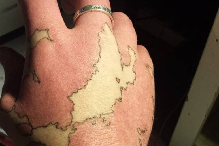 Is That a Tattoo or a Skin Condition?