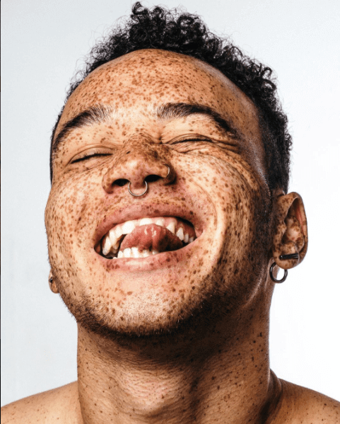 Uma Modelo Com O Rosto Totalmente Coberto De Sardas