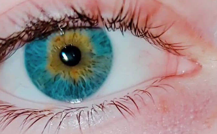 Another Form Of Heterochromia Known As Central Heterochromia