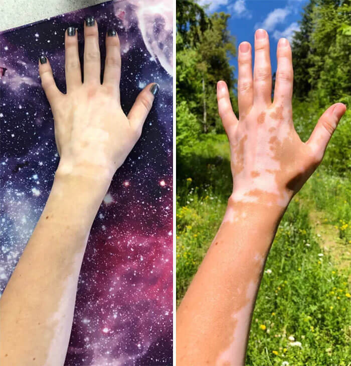 This Person's Vitiligo Changes With The Seasons