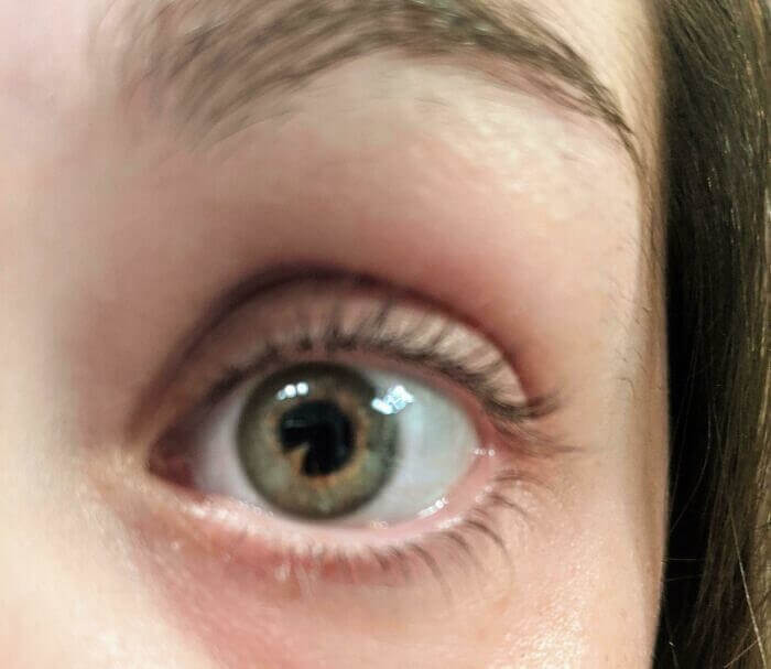 This Girl Has A Misshaped Iris That Resembles Pacman