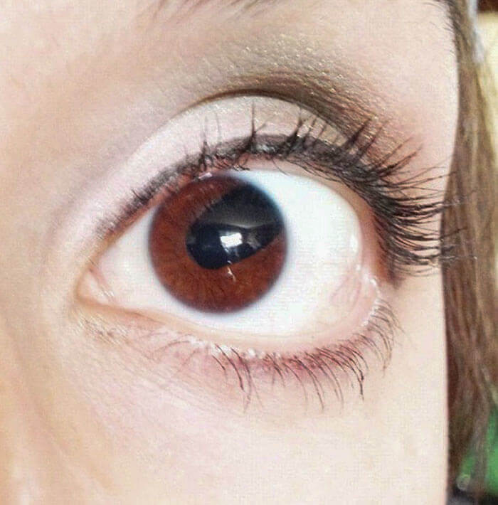 This Girl Was Born With A Condition Called Coloboma