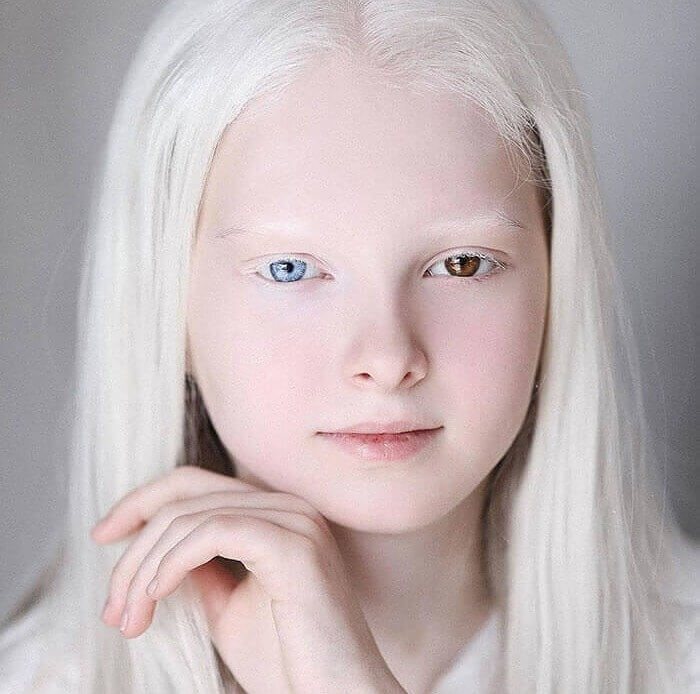 Esta Menina Tem Albinismo E Heterocromia