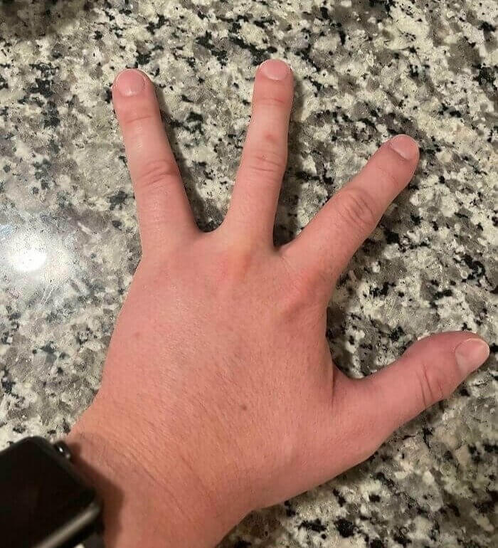 This Guy Was Born With Four Fingers