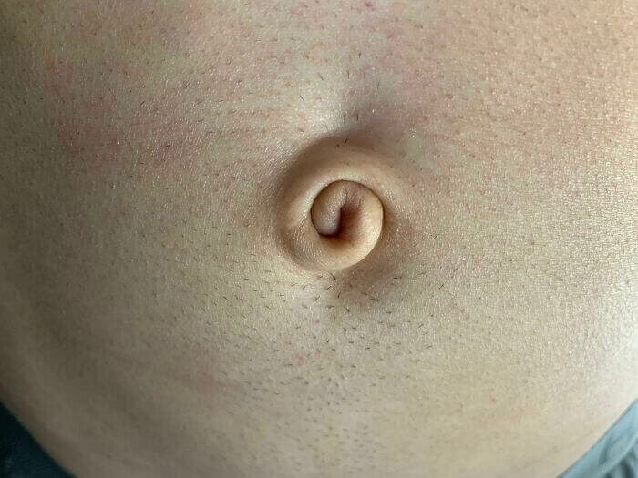 This Person Has One Of The Rarest Belly Button Shapes
