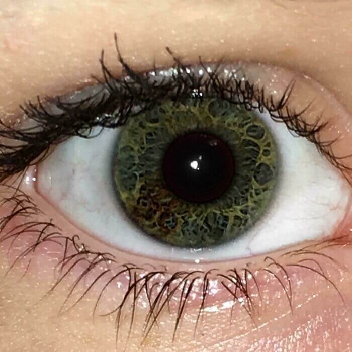 A Unique Eye Pattern And Sectoral Heterochromia