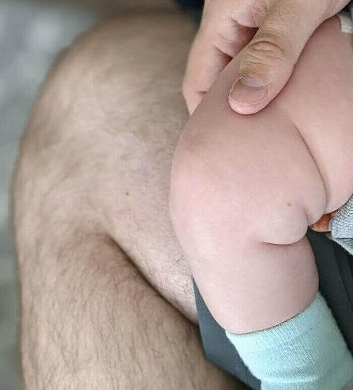 Baby Is Born With The Same Freckle As Dad's