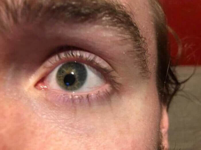 This Person Has An Off Center Pupil