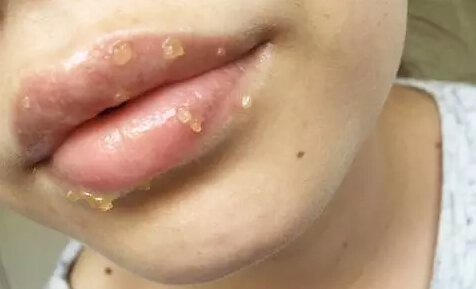Raw Honey Is the New Chapstick