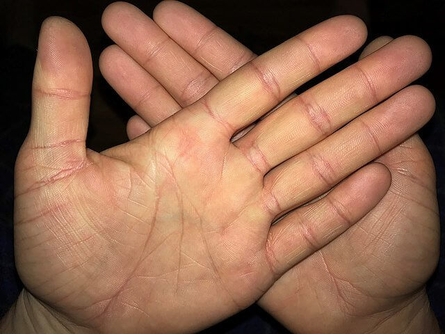 Baking Soda Can Be Used to Remove Splinters