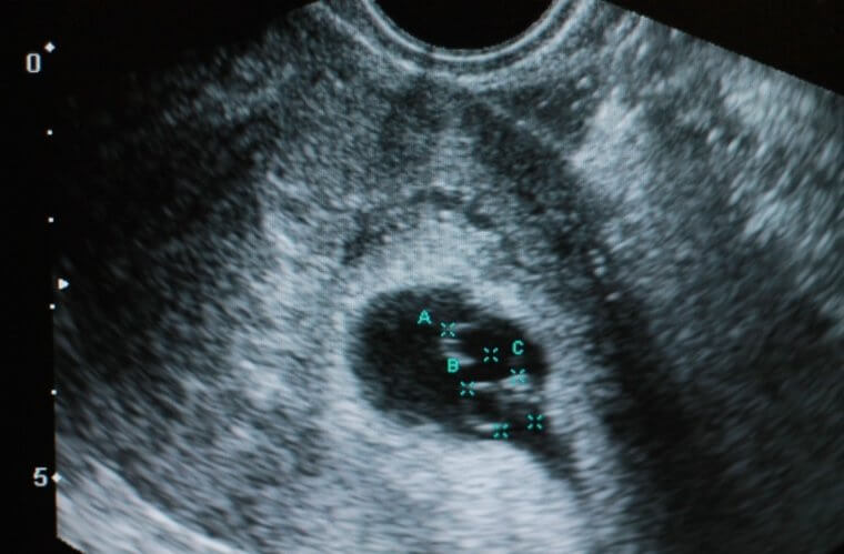 More Than Just Normal Triplets