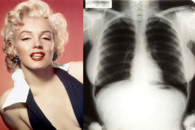 Someone Bought Marilyn Monroe's Chest X-Ray
