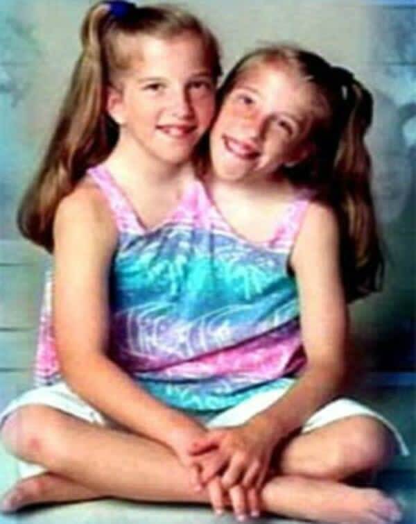 A história de Abby e Brittany Hensel, as famosas gêmeas conjugadas