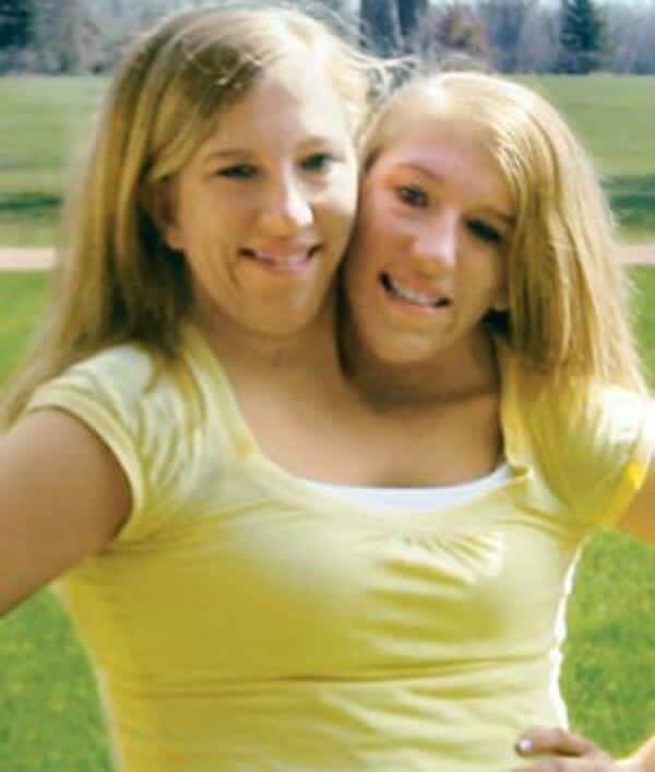 A história de Abby e Brittany Hensel, as famosas gêmeas conjugadas
