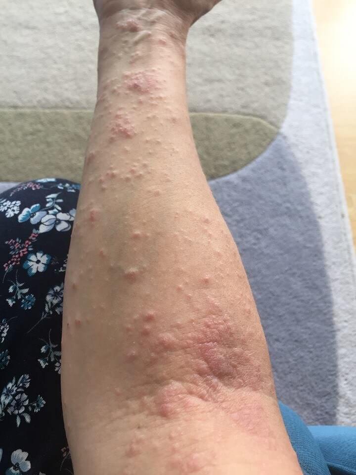 Die Entwicklung des Immunsystems wird von der Mutter vererbt