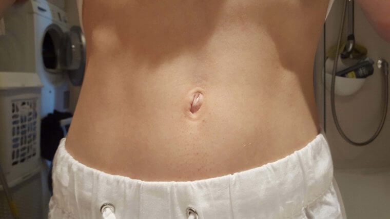 Only 1 Percent Of People Have Outie Belly Buttons