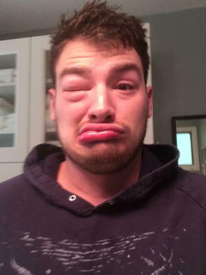 When You're Allergic to Cats and Sleep Near a Cat