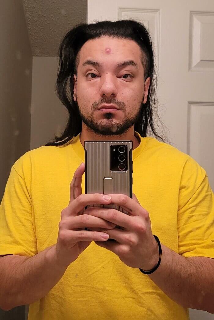 When a Pimple Swells Your Whole Face