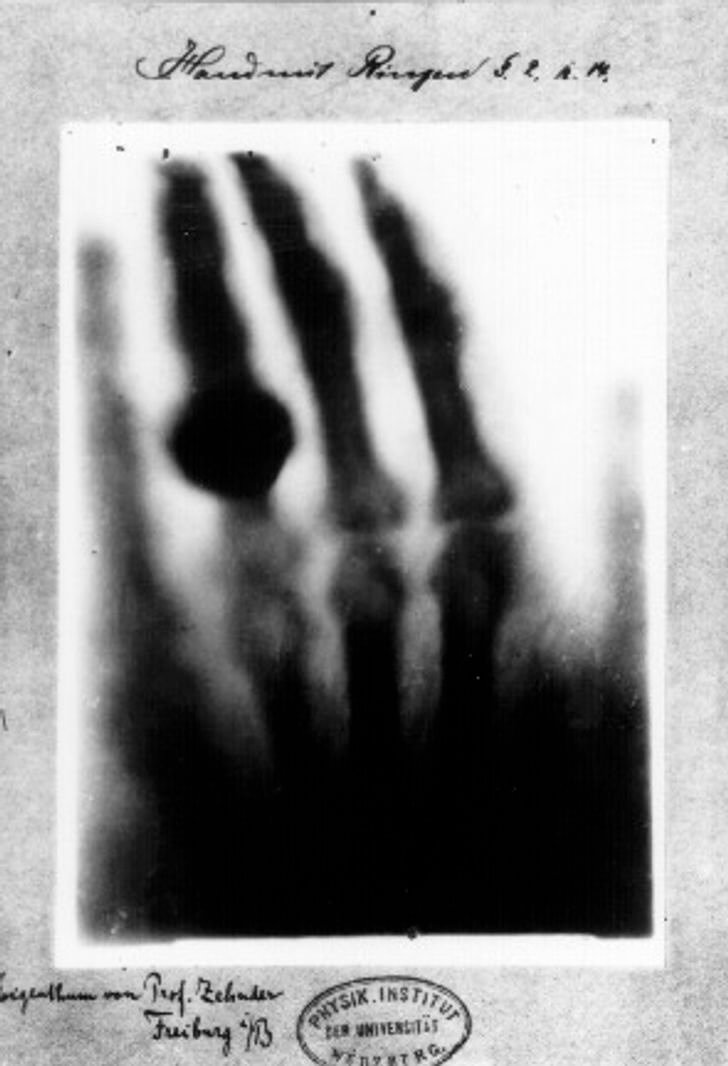 Los Primeros Rayos X Tomados De La Mano De W. C. Röntgen