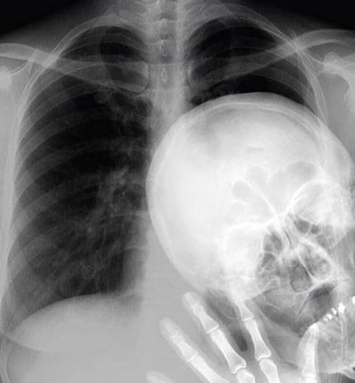 Una Persona Que Arruina Fotos Esta Suelta En La Sala De Rayos X En Este Hospital